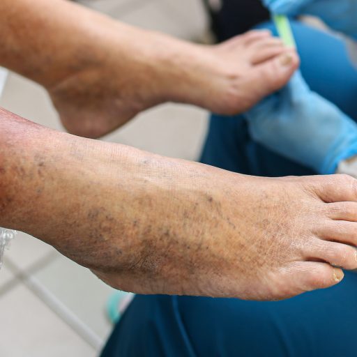 Φλεβικά έλκη: Πού οφείλονται & πώς αντιμετωπίζονται