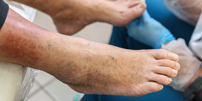 Φλεβικά έλκη: Πού οφείλονται & πώς αντιμετωπίζονται