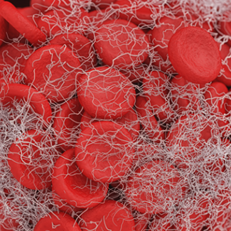 Φλεβική Θρόμβωση. Ένα Συχνό Νόσημα Με Πολλές Επιπλοκές