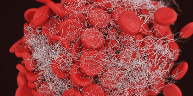 Φλεβική Θρόμβωση. Ένα Συχνό Νόσημα Με Πολλές Επιπλοκές