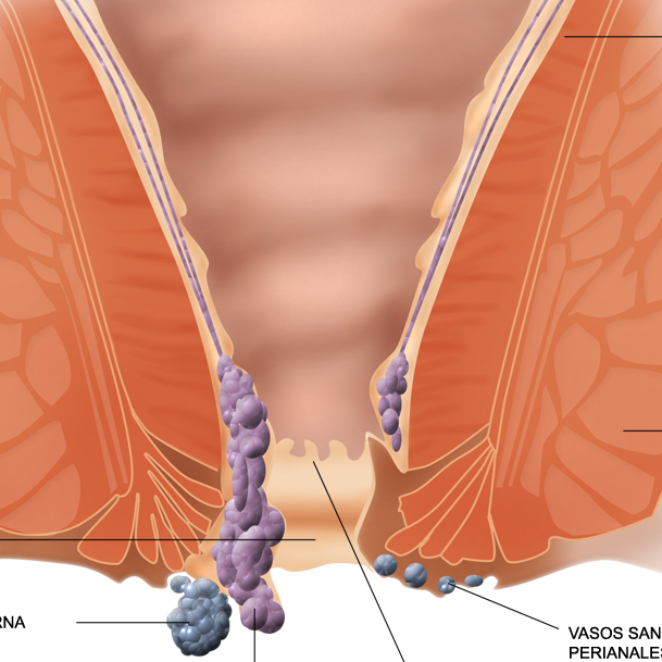 Χειρουργικές θεραπείες αιμορροΐδων