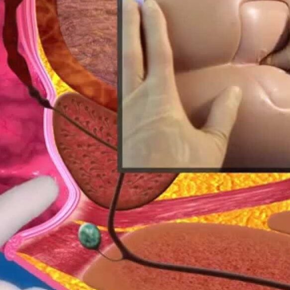 Ψηφιακή εξέταση ορθού