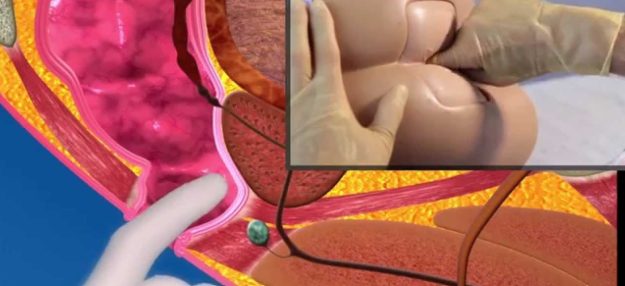 Ψηφιακή εξέταση ορθού