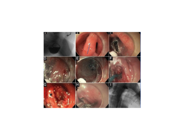 Θεραπεία εκκολπώματος Ζένκερ σε ηλικιωμένο ασθενή με δυσκαταποσία