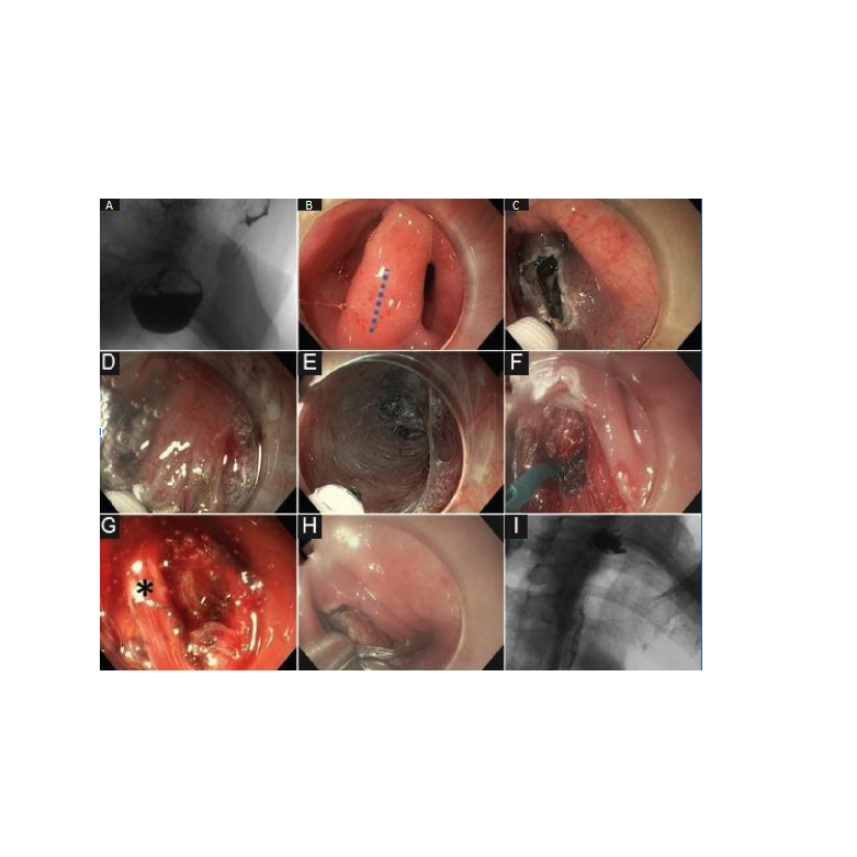 Θεραπεία εκκολπώματος Ζένκερ σε ηλικιωμένο ασθενή με δυσκαταποσία