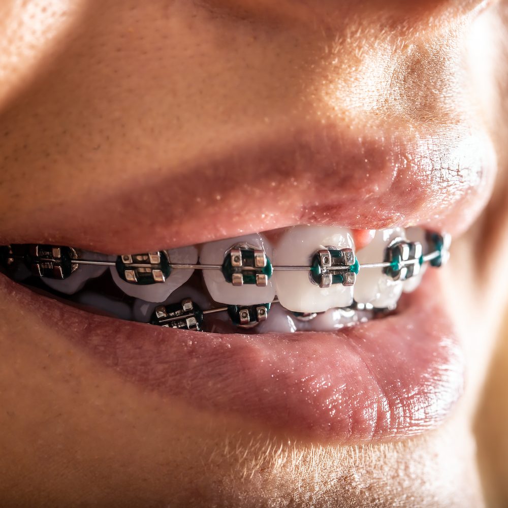 Τερηδόνα κατά την ορθοδοντική θεραπεία