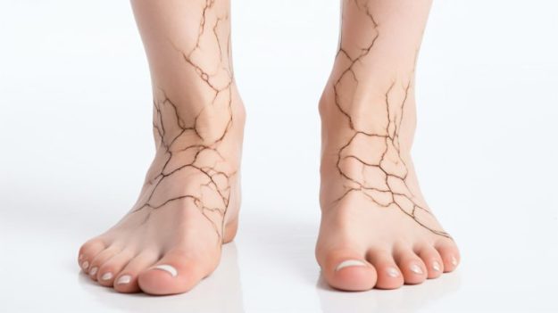 Φλεβική ανεπάρκεια