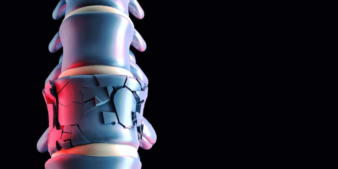 Κάταγμα σπονδύλου