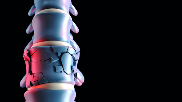 Κάταγμα σπονδύλου