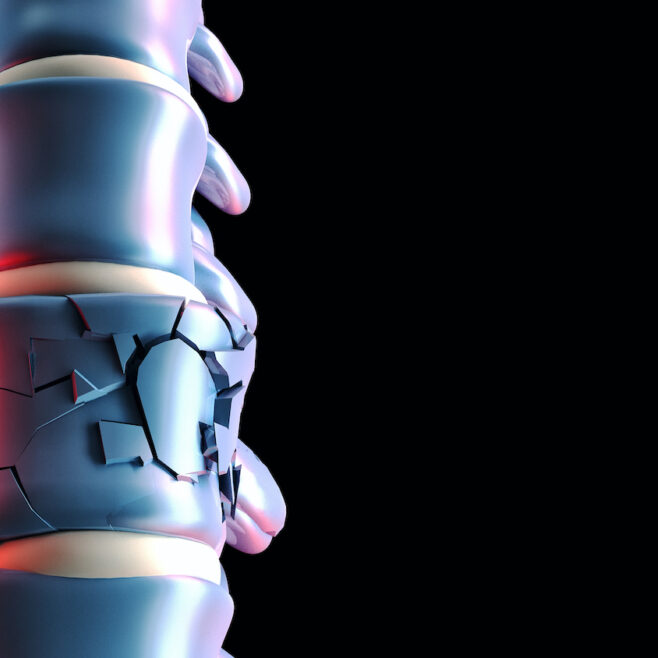 Κάταγμα σπονδύλου