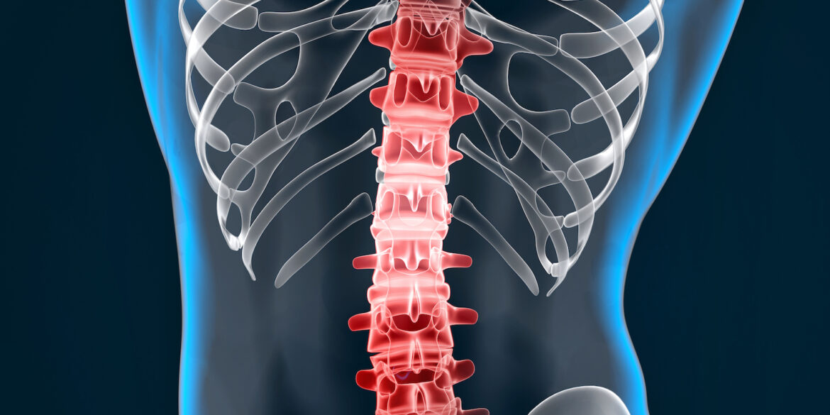 Πίεση νωτιαίου μυελού και συμπτώματα που προκαλεί: Τρόποι αντιμετώπισης Πίεση νωτιαίου μυελού και συμπτώματα που προκαλεί: Τρόποι αντιμετώπισης