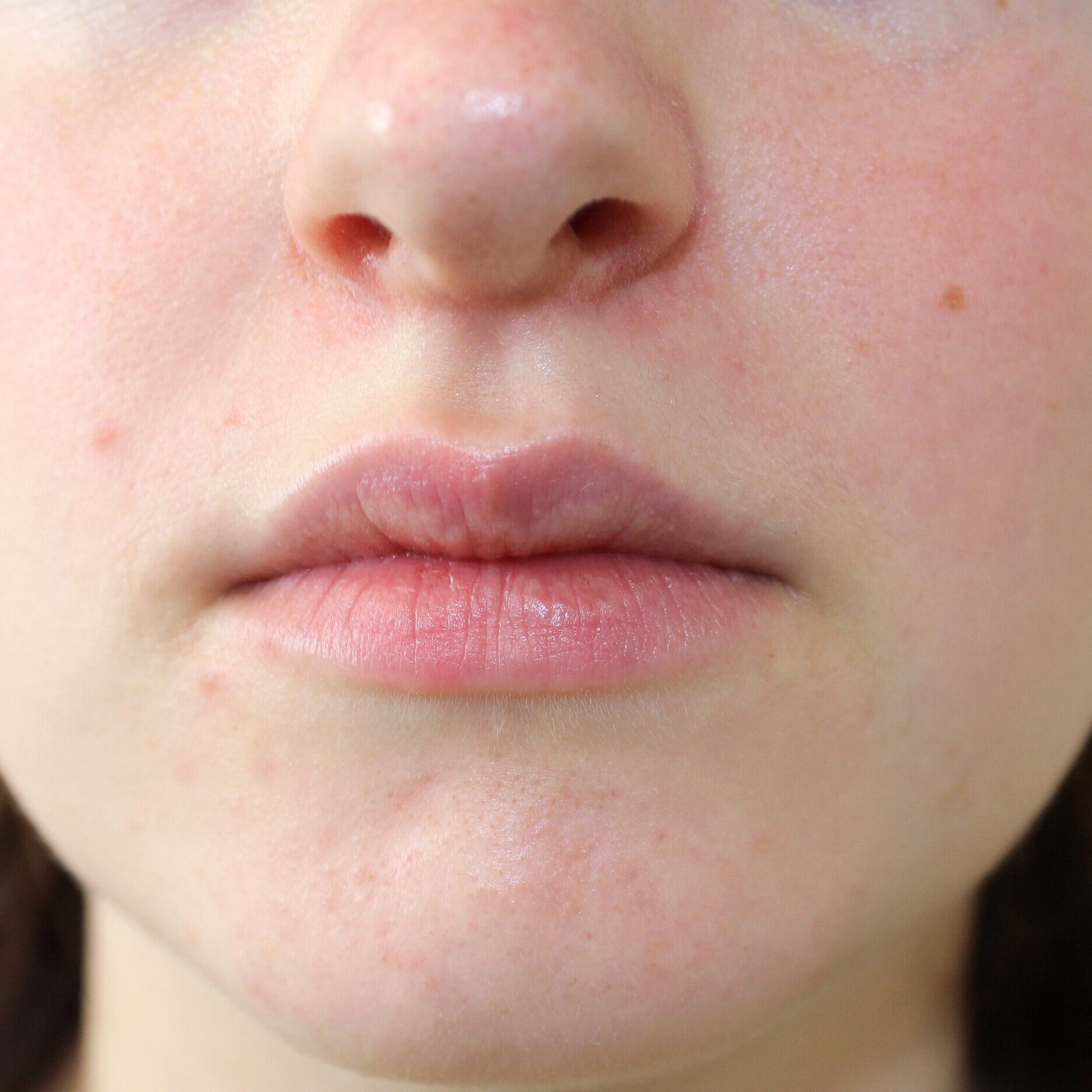 Περιστοματική δερματίτιδα