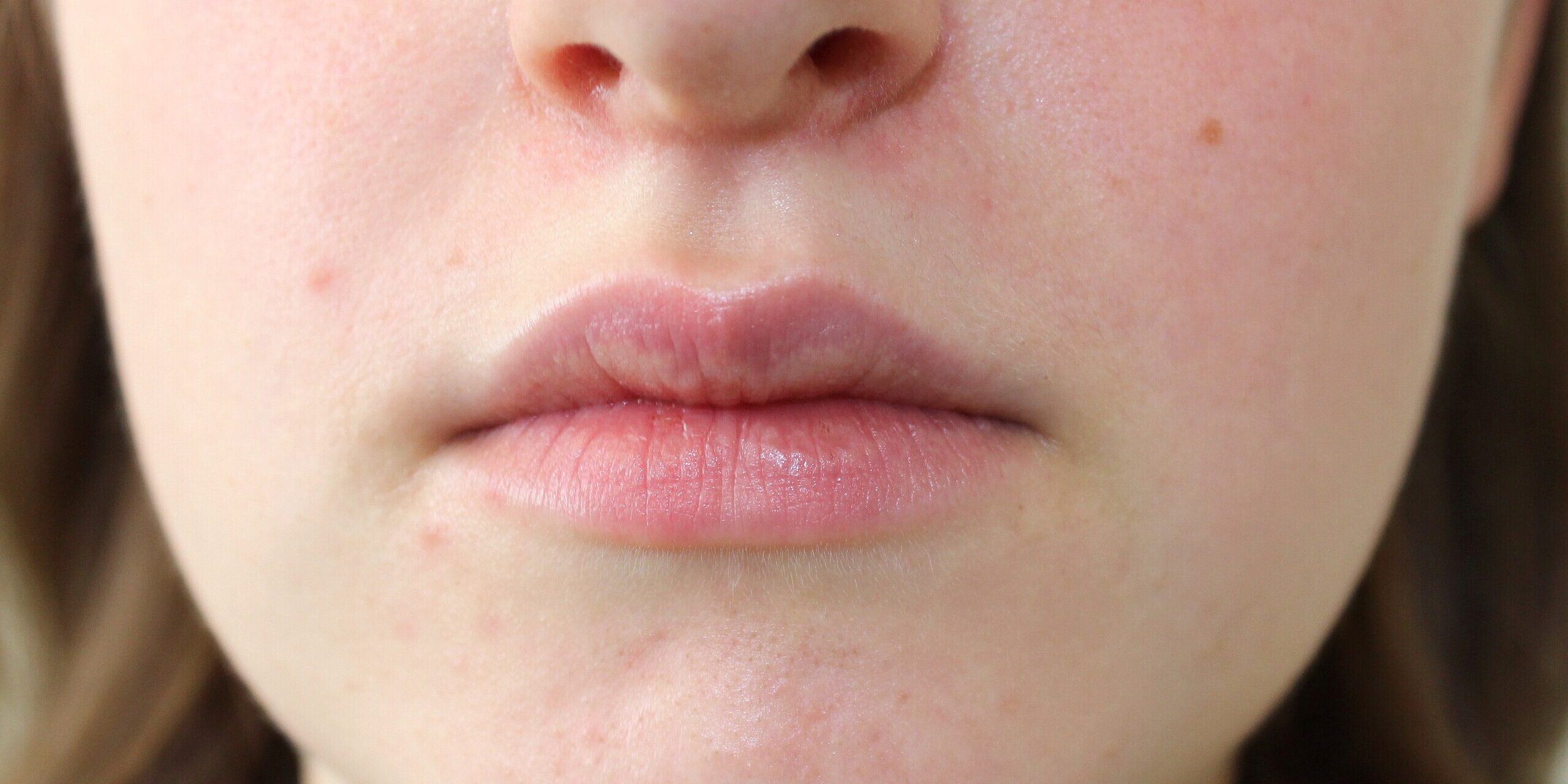 Περιστοματική δερματίτιδα