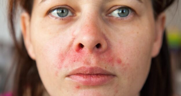 Περιστοματική δερματίτιδα