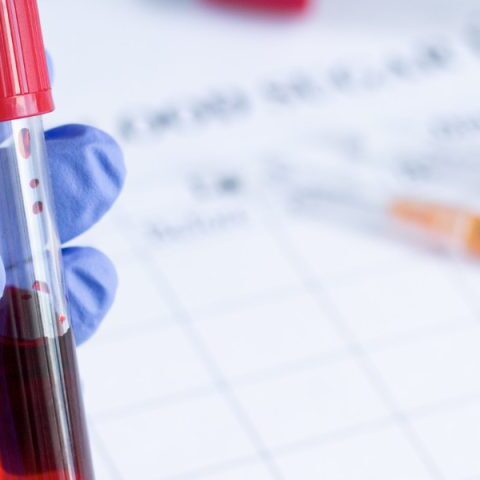 Αιτίες ανεβασμένου PSA και σχέση με καρκίνο προστάτη