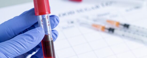 Αιτίες ανεβασμένου PSA και σχέση με καρκίνο προστάτη