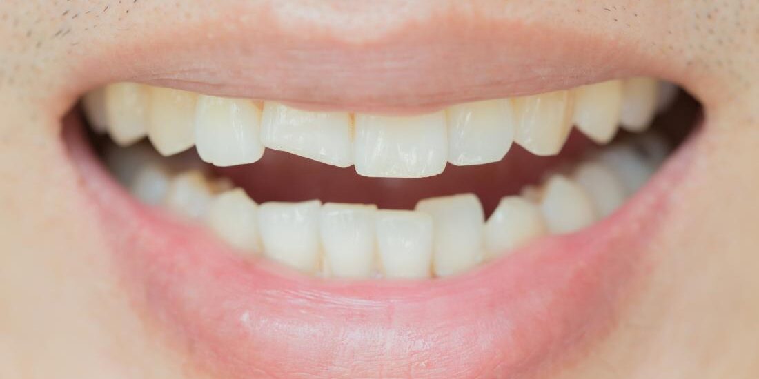 Σπασμένο δόντι: Πώς αποκαθίσταται;