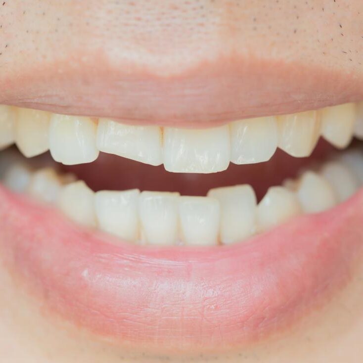 Σπασμένο δόντι: Πώς αποκαθίσταται;