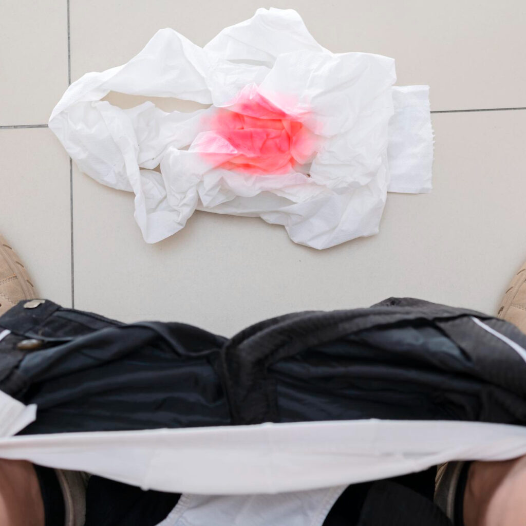 Αίμα από τις αιμορροΐδες: Είναι ανησυχητικό;