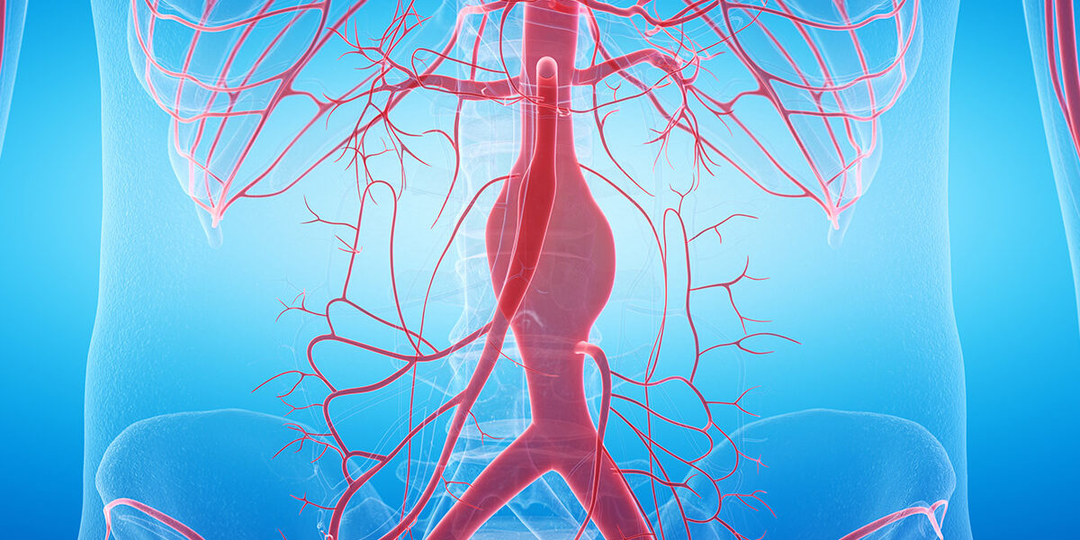 Ανεύρυσμα κοιλιακής αορτής και συμπτώματα που προκαλεί Ανεύρυσμα κοιλιακής αορτής και συμπτώματα που προκαλεί