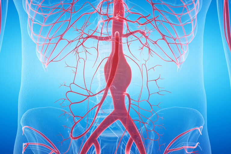 Ανεύρυσμα κοιλιακής αορτής και συμπτώματα που προκαλεί Ανεύρυσμα κοιλιακής αορτής και συμπτώματα που προκαλεί