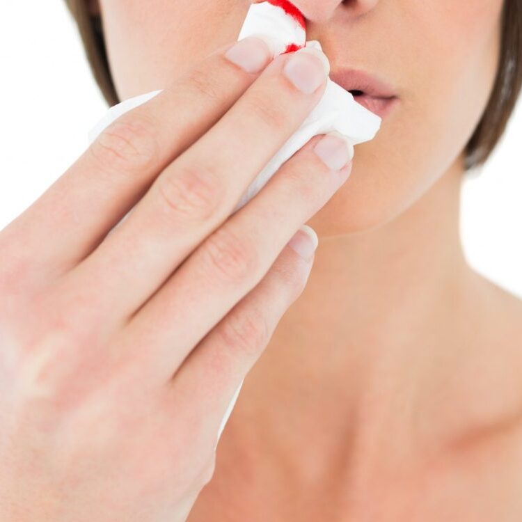 Ρινορραγία: Αίτια & αντιμετώπιση