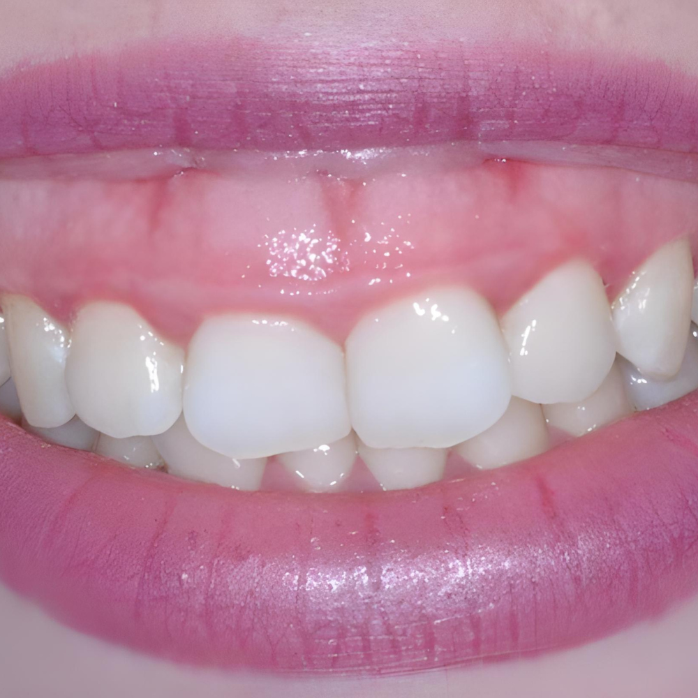 Ουλικό χαμόγελο και διόρθωση με ορθοδοντική θεραπεία