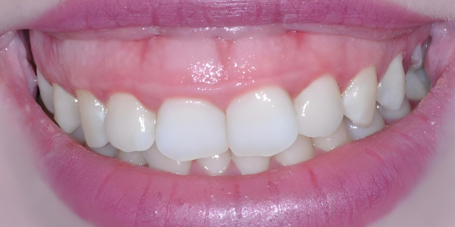 Ουλικό χαμόγελο και διόρθωση με ορθοδοντική θεραπεία Ουλικό χαμόγελο και διόρθωση με ορθοδοντική θεραπεία