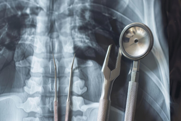 σπονδυλοδεσία χρόνος αποκατάστασης