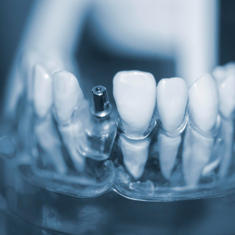 εμφυτεύματα δοντιών