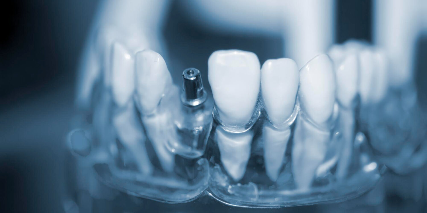 εμφυτεύματα δοντιών εμφυτεύματα δοντιών