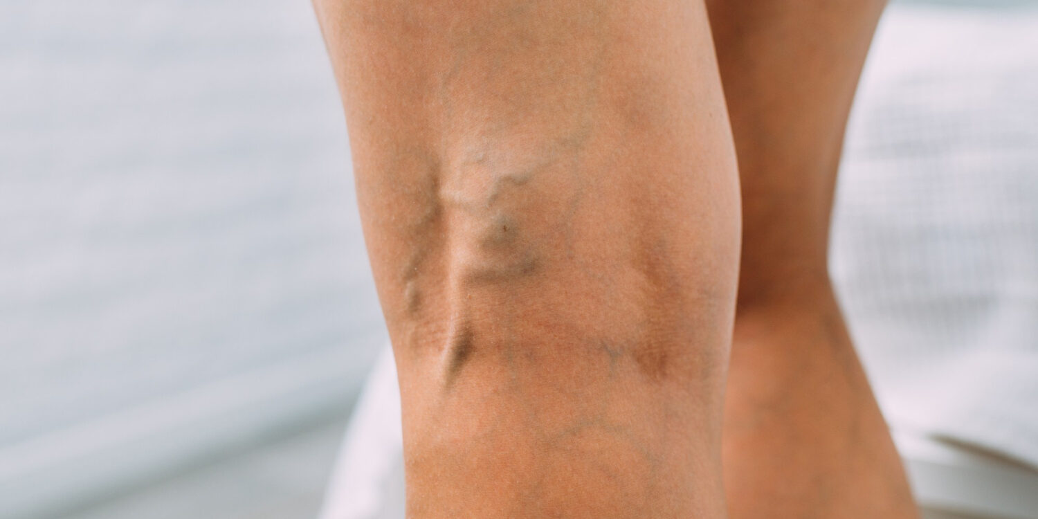 αφαίρεση κιρσών με λέιζερ