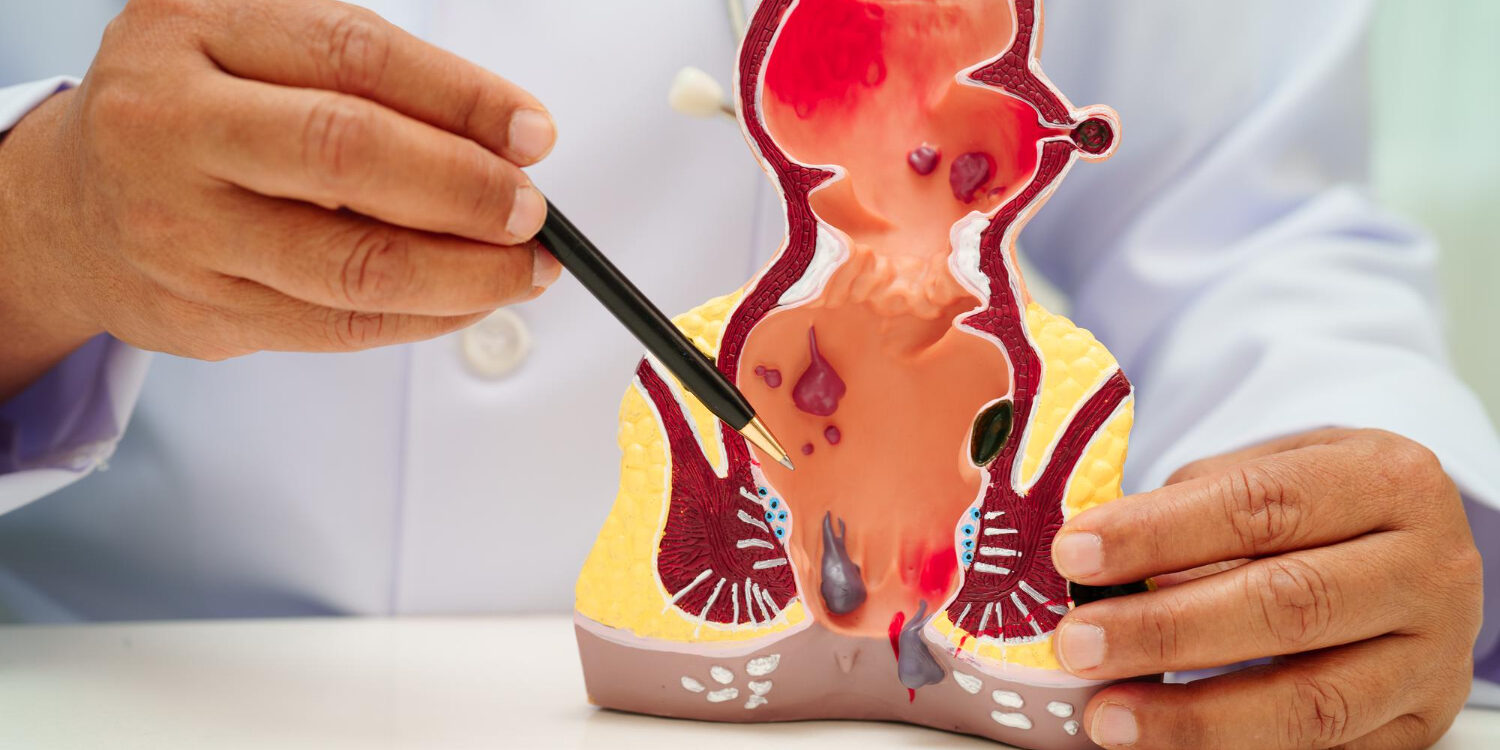 καλύτερος χειρουργός για αιμορροΐδες στην Αθήνα