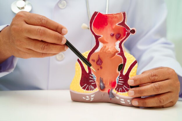 καλύτερος χειρουργός για αιμορροΐδες στην Αθήνα