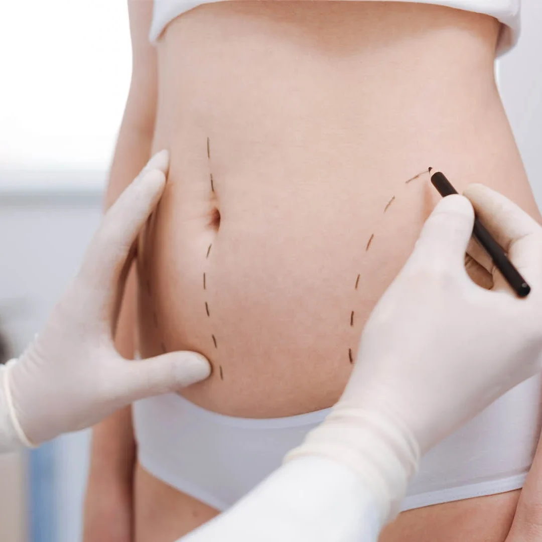 lipoanarrofisi vaser