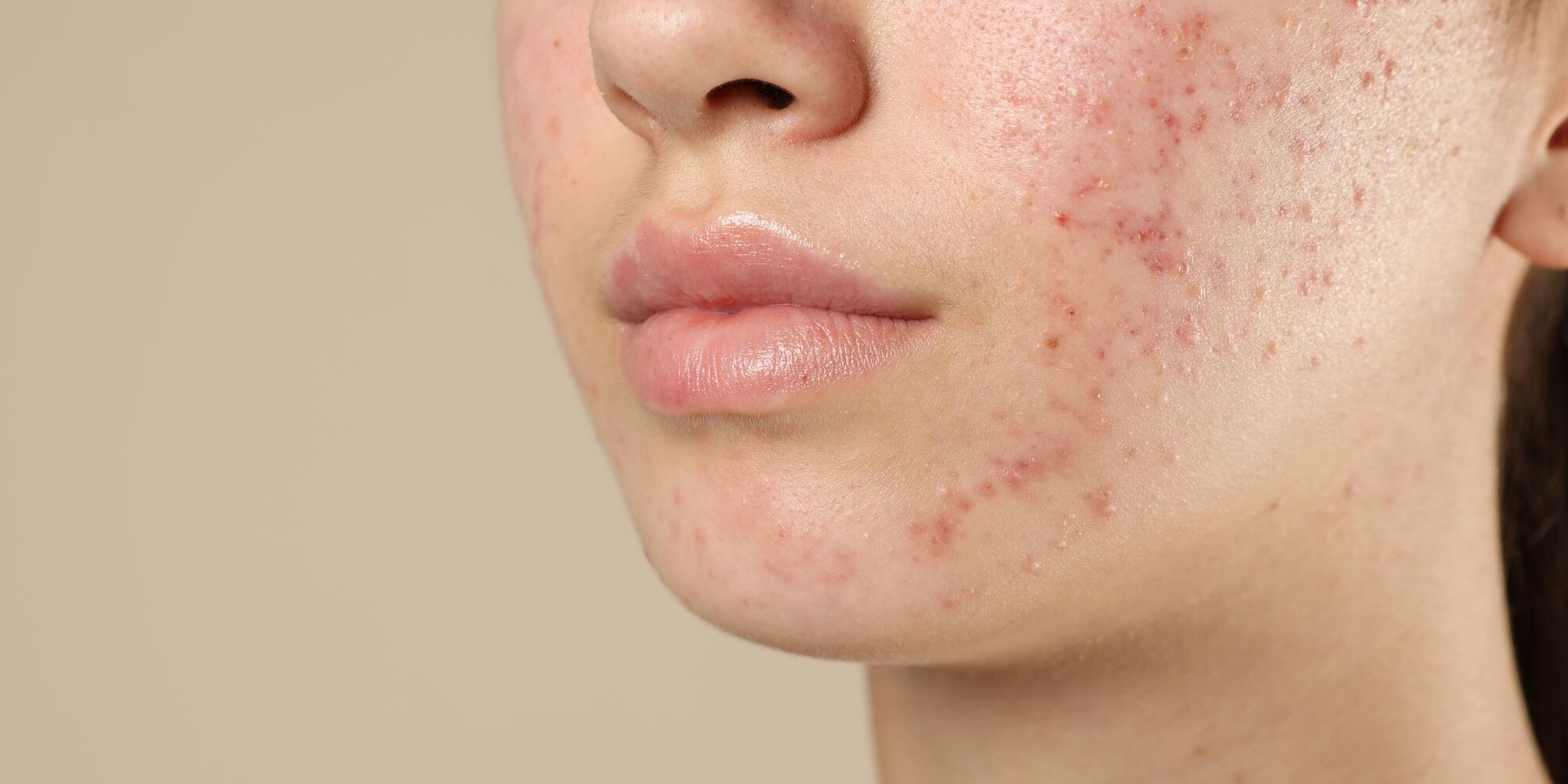 oi kaliteroi dermatologoi gia akmi