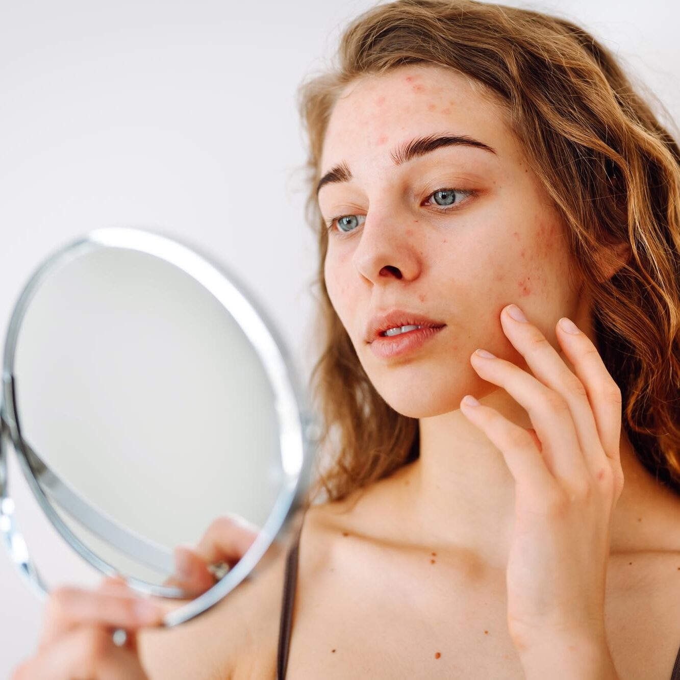 Τι είναι η ακμή;