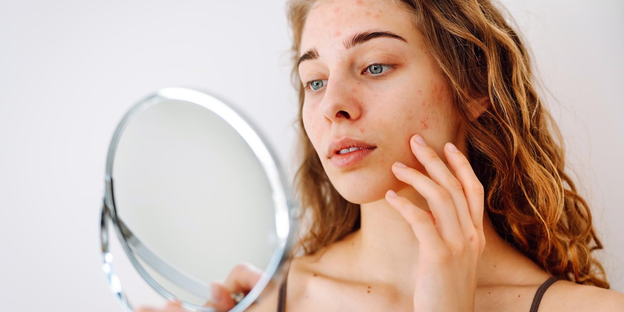 Τι είναι η ακμή;