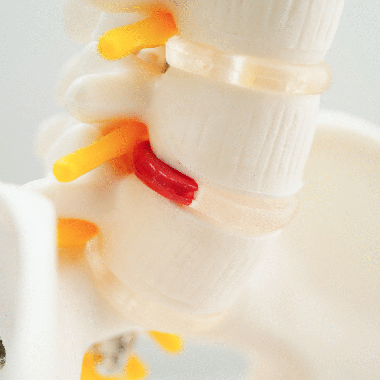 Τι είναι η δισκοκήλη