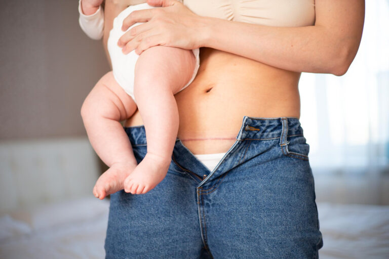 mommy makeover
