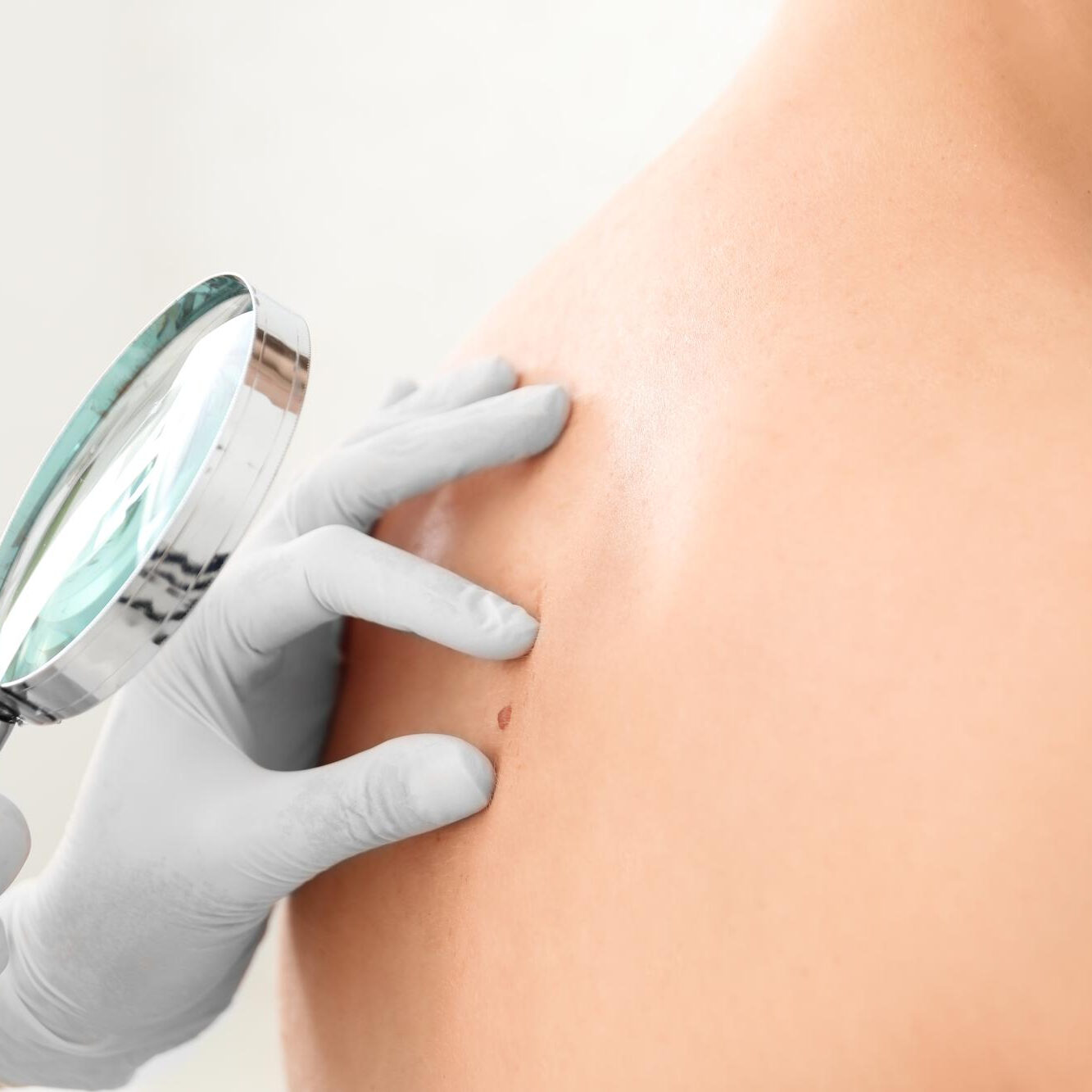 Ελιά στο Δέρμα