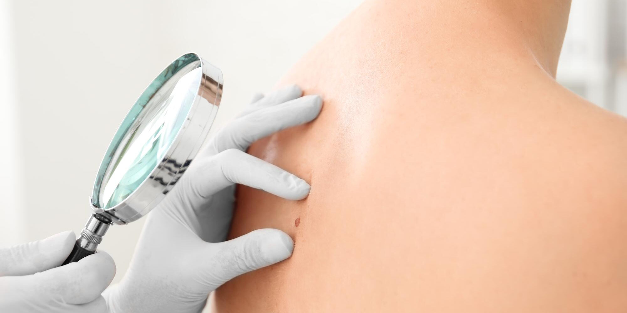 Ελιά στο Δέρμα Ελιά στο Δέρμα