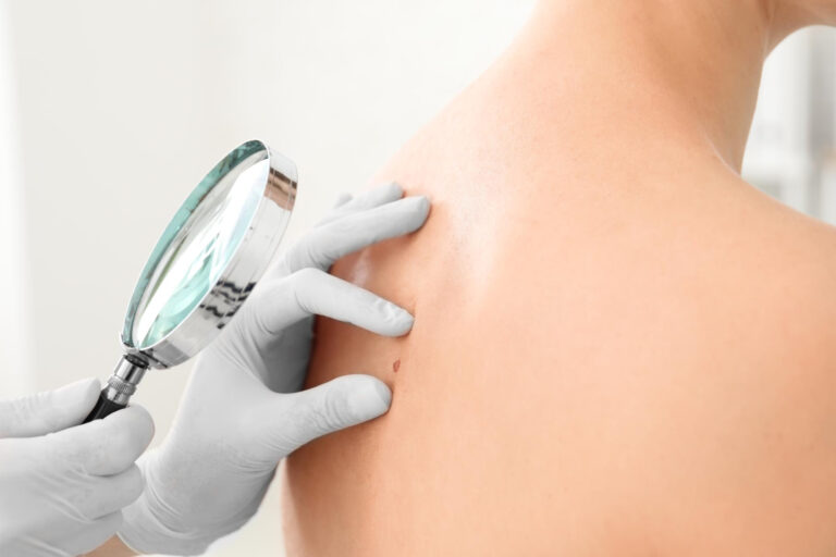 Ελιά στο Δέρμα