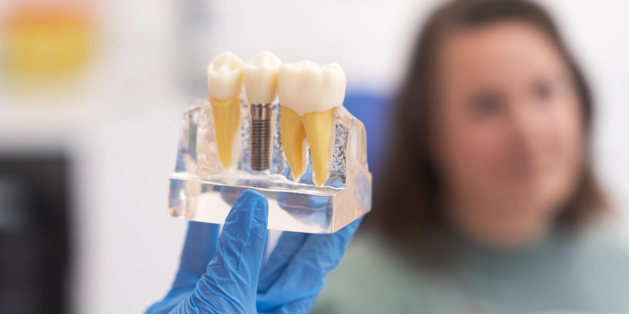 Εμφυτεύματα Δοντιών