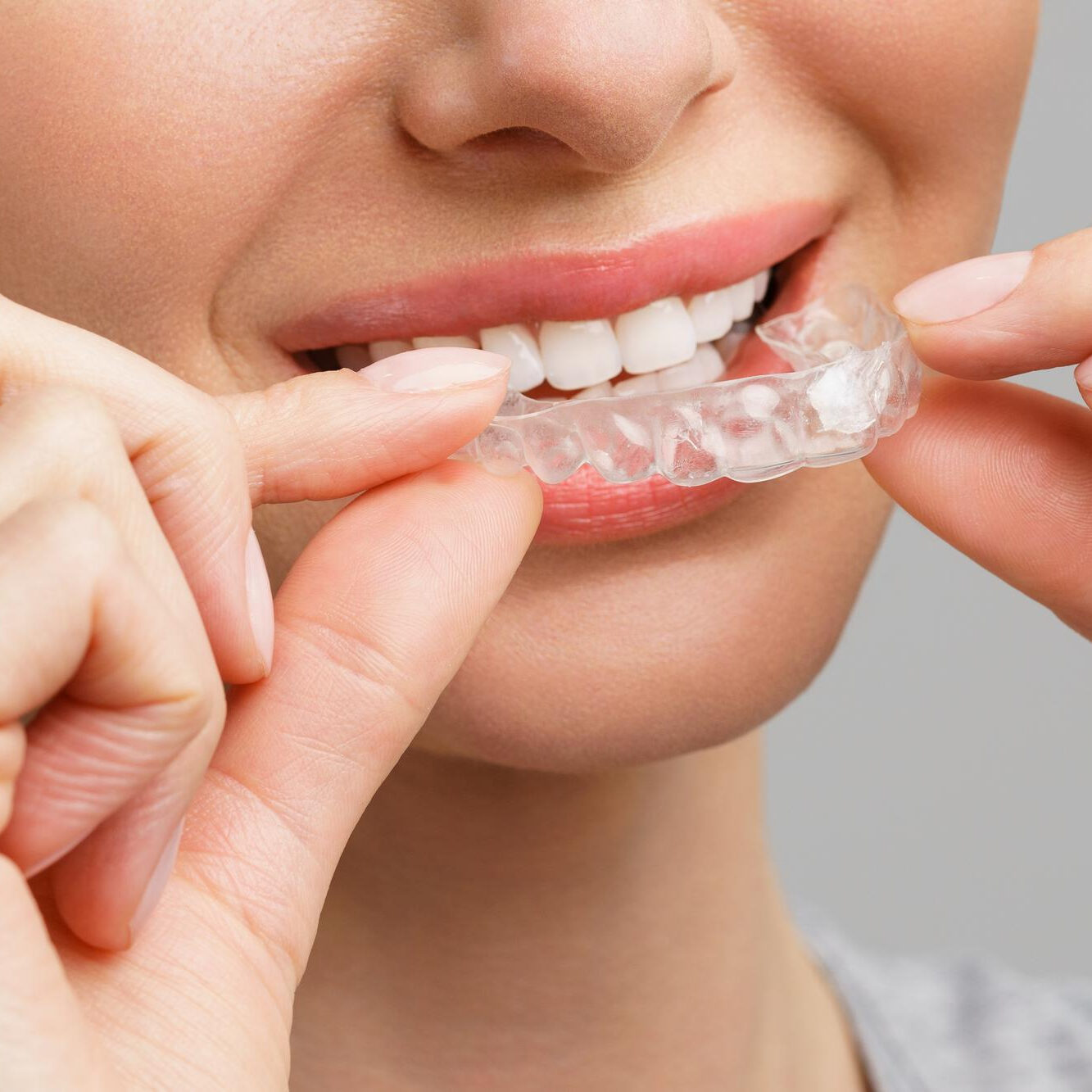 Οι Καλύτεροι Ορθοδοντικοί Invisalign