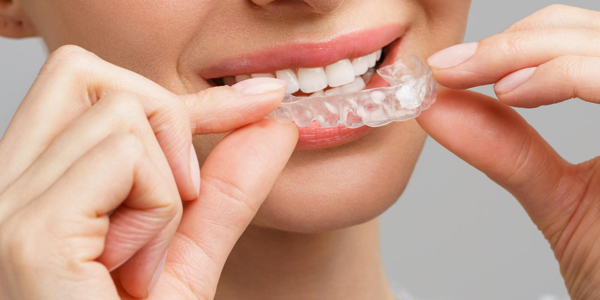 Οι Καλύτεροι Ορθοδοντικοί Invisalign Οι Καλύτεροι Ορθοδοντικοί Invisalign