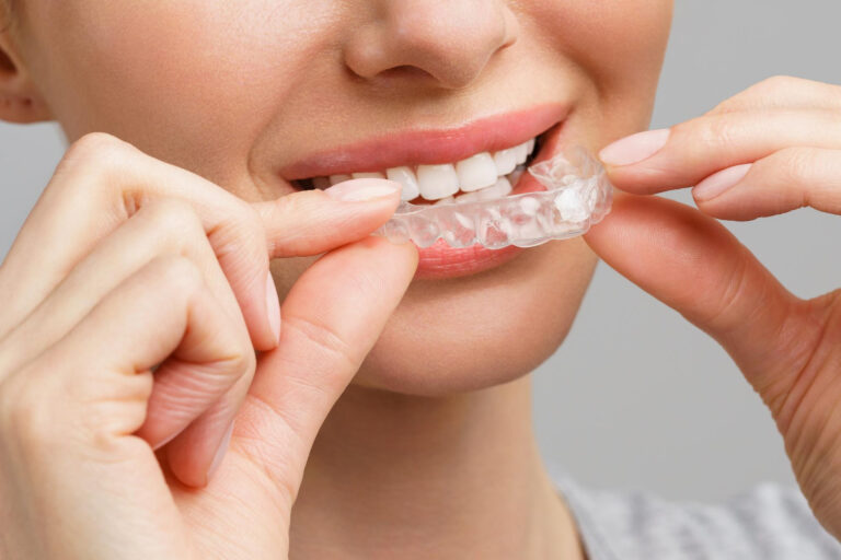 Οι Καλύτεροι Ορθοδοντικοί Invisalign