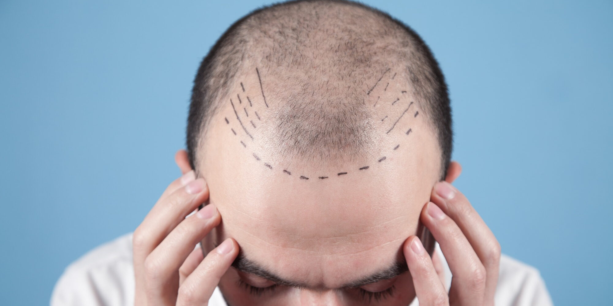 Τι είναι η μέθοδος FUT Τι είναι η μέθοδος FUT