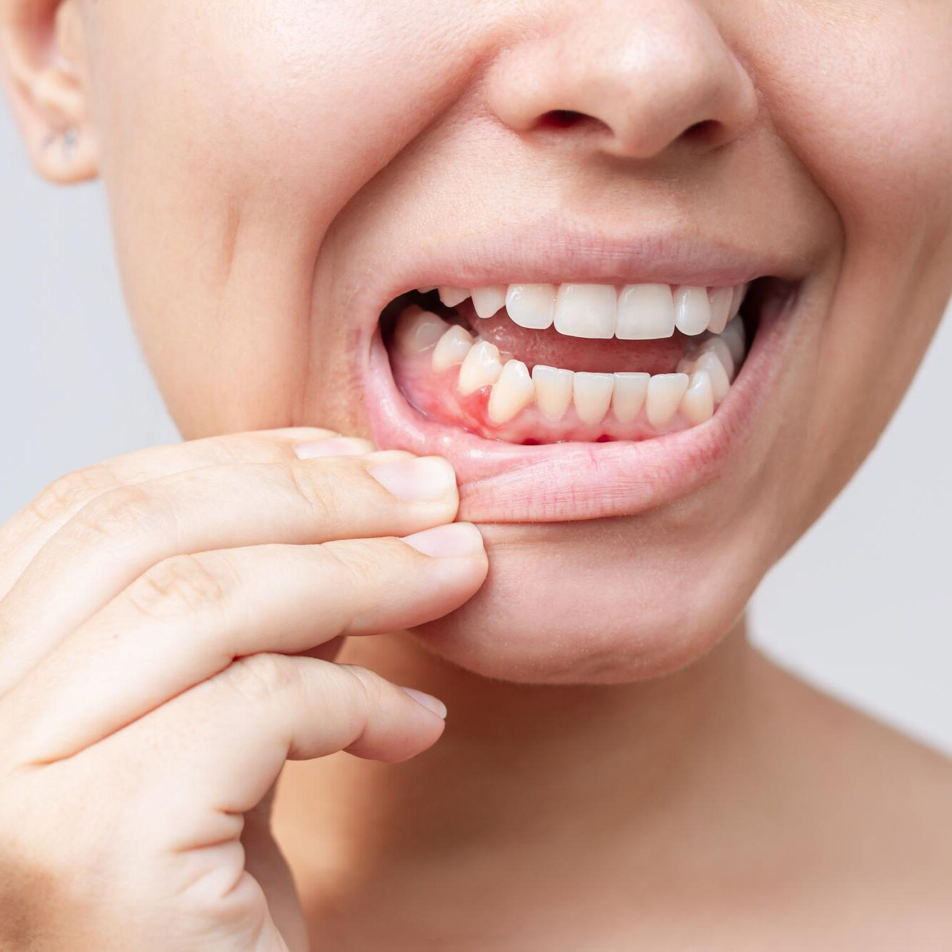 Τι είναι η ουλίτιδα