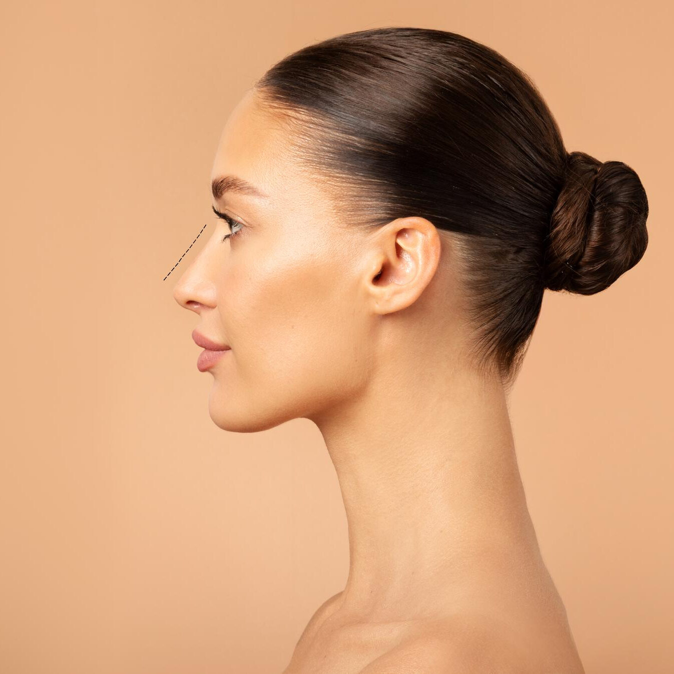 Τι είναι η ρινοπλαστική